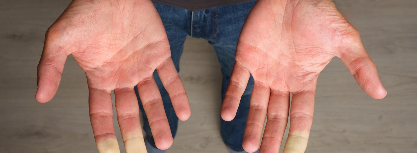 Close-up of a person’s outstretched hands showing pale, discoloured fingertips, commonly associated with Raynaud’s phenomenon.